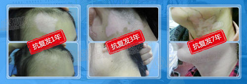 抗复发诊疗档案